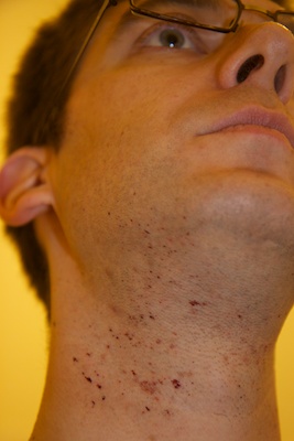 Alexander bleeding from cuts